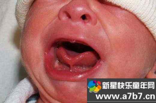 什么是舌系带过短，宝宝何时适合进行舌系带手术