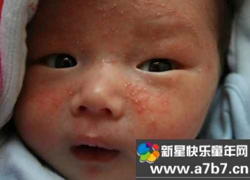 新生儿湿疹的诱发原因有哪些