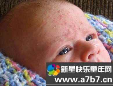 婴儿脸上湿疹怎么办最佳治疗方法是什么