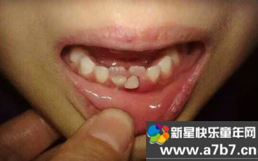 儿童乳牙没掉长出恒牙怎么办如何预防双排牙